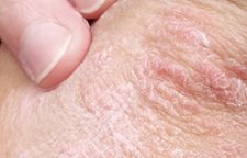 Longuent du psoriasis le plus bon