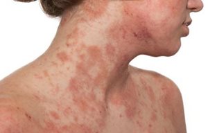 Décolleté et bas du visage d'une femme avec la peau infectée