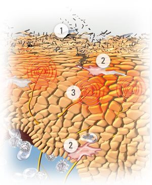 Illustration de la peau avec les symptômes de la dermatite atopique