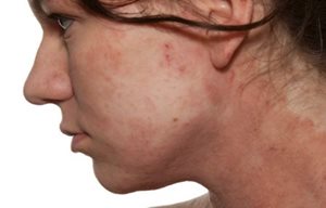 Profil de femme avec des rougeurs sur la joue