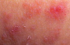 Peau infectée et squameuse